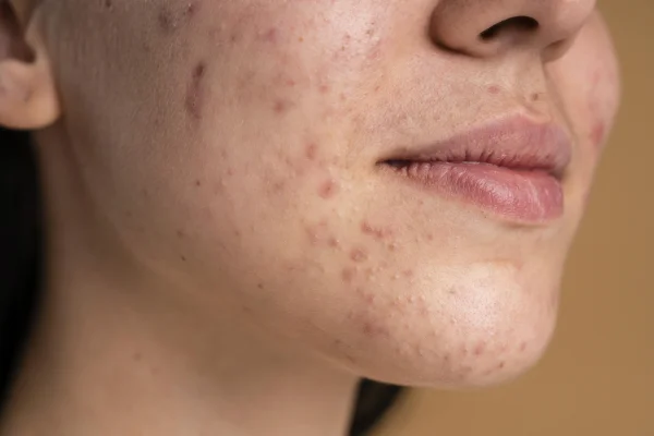 Can Acne Scars Be Removed Completely?