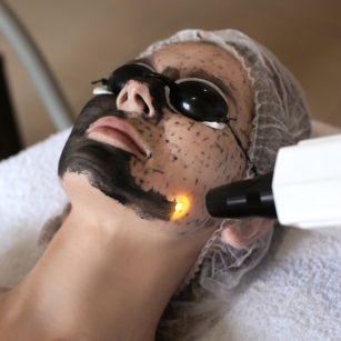 carbon laser skin toning Hyderabad