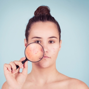 Acne treatment in Hyderabad