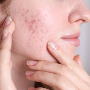 acne scar treatment in Hyderabad