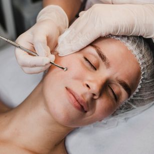 acne scar treatment in Hyderabad