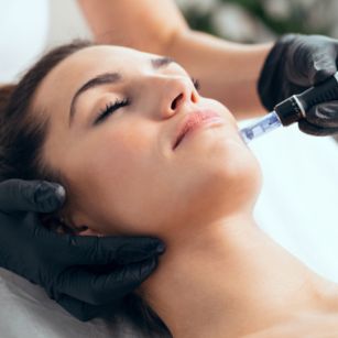 Acne treatment in Hyderabad