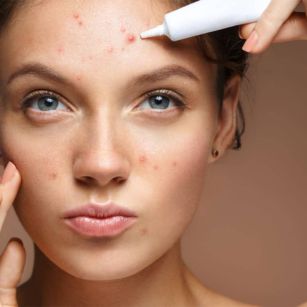 Acne scars treatment