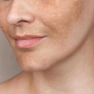 melasma treatment