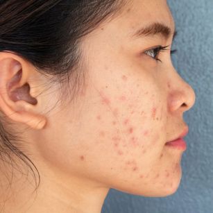 acne scar treatment in hyderabad