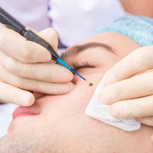 Mole Removal in Hyderabad