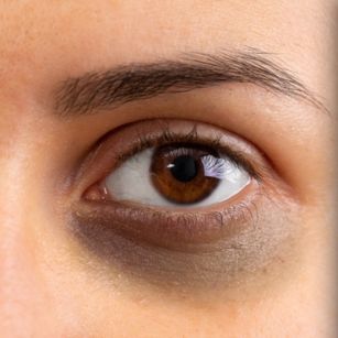 Dark Circles Treatment