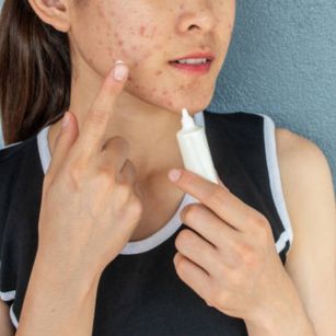 Acne treatment in Hyderabad