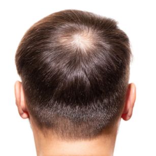 hair fall treatment in Hyderabad