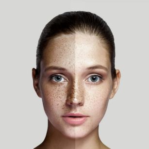 pigmentation treatment in Hyderabad