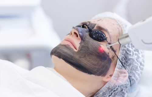 Carbon Laser Peel Treatment in Hyderabad