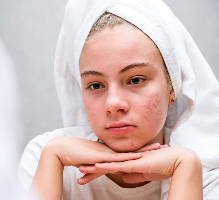 Acne Treatment in Hyderabad | Acne Treatment Cost in Hyderabad