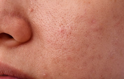 Skincare Tips to Prevent Open Pores
