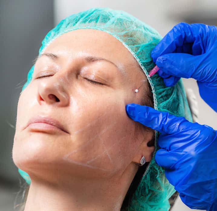 How is Thread Facelift Performed?