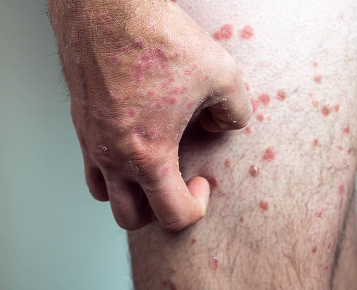 How can Psoriasis be Treated?