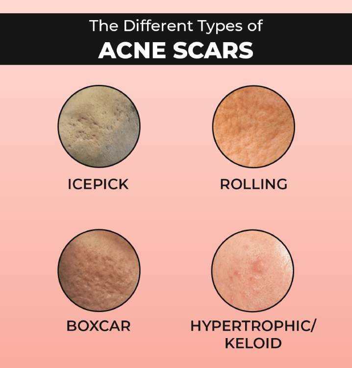 Types of Acne Scars: Icepick, Rolling, Boxcar, Hypertrophic/Keloid. Types of Acne Scar Treatment In Hyderabad: Subcision, Chemical Peel