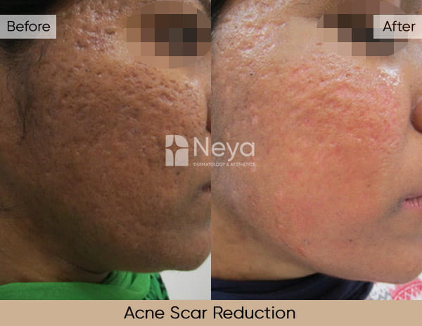 Acne Scar Reduction results