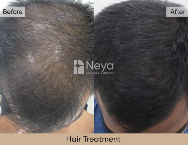 Results of Hair Treatment