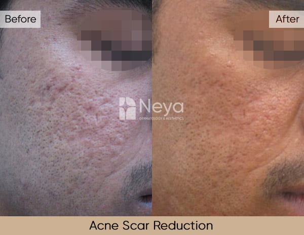 Acne Scar Reduction