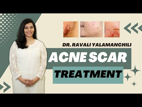 Dermatologist explains Acne scars and it's treatment options