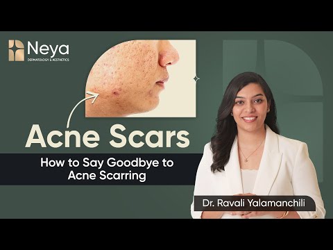 Acne Marks & Acne Scars | How to Reclaim Clear, Smooth Skin | Acne Scars Treatment in Hyderabad