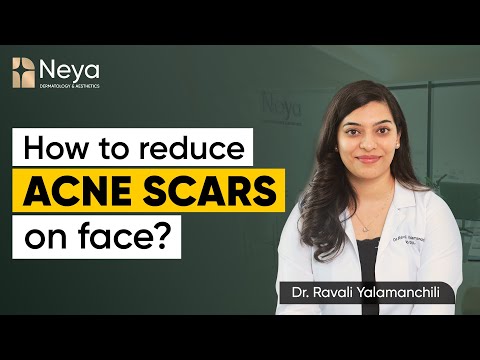 Acne Marks & Acne Scars | How to reduce acne scars on face? | Acne Scars Treatment in Hyderabad