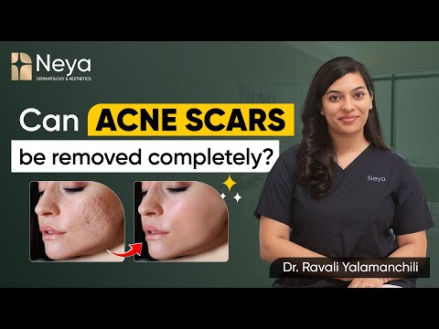How to get rid of acne scars? | Skin specialist in Hyderabad | Dr. Ravali Yalamanchili