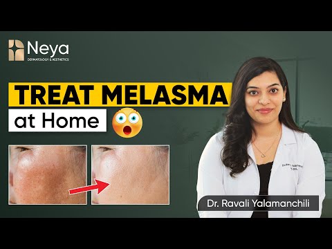 Melasma treatment by dermatologist | How to prevent dark spots | Melasma treatment in Hyderabad
