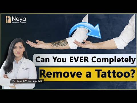 Laser Tattoo Removal treatment | Skin Specialist in Hyderabad | Dr. Ravali Yalamanchili