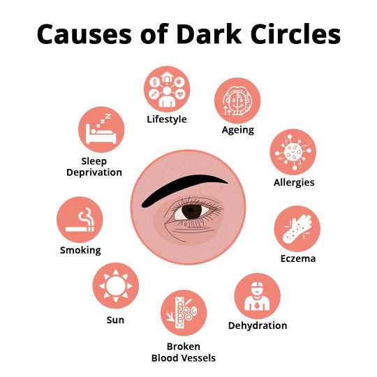 Causative Factors/ Triggers of Dark Circles Treatment In Hyderabad. Causes of Dark Circles: Lifestyle, Sleep Deprivation, Eczema and more.