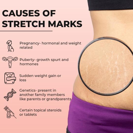 Causes  of Stretch Marks: Pregnancy- hormonal and weight related, Puberty-growth spurt and hormones, Certain topical steroids or tablets