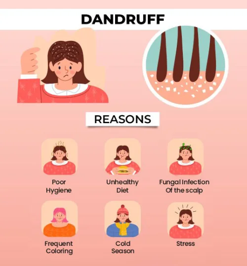 Causes of Dandruff: Poor Hygiene, Unhealthy Diet, Stress, Frequent Coloring, Cold Season, and Fungal Infection of the scalp.