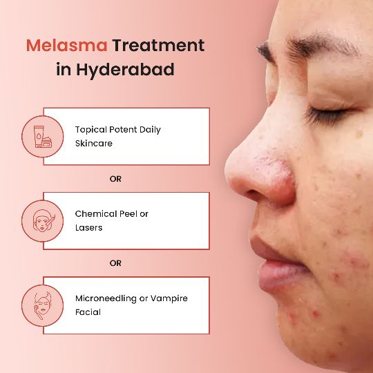 What are the Best Medical Options for Melasma Treatment In Hyderabad: Chemical Peel or Lasers Treatment, Microneedling or Vempire Facial 