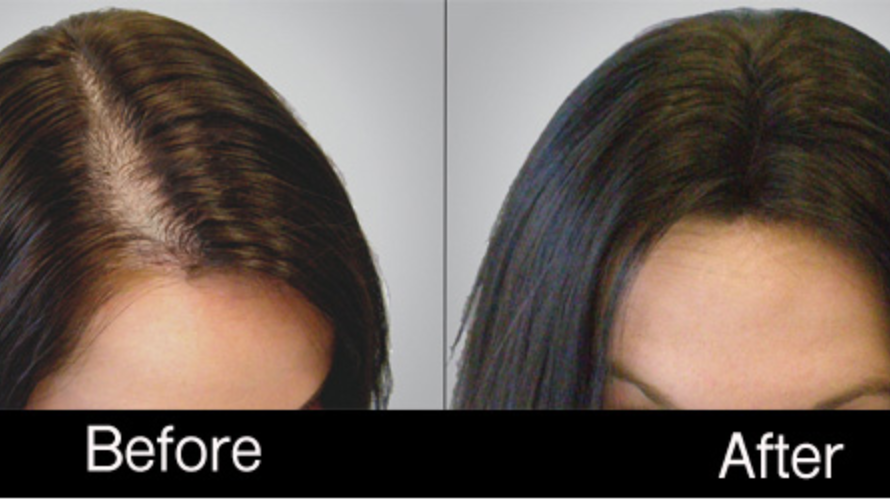 PRP hairfall treatment
