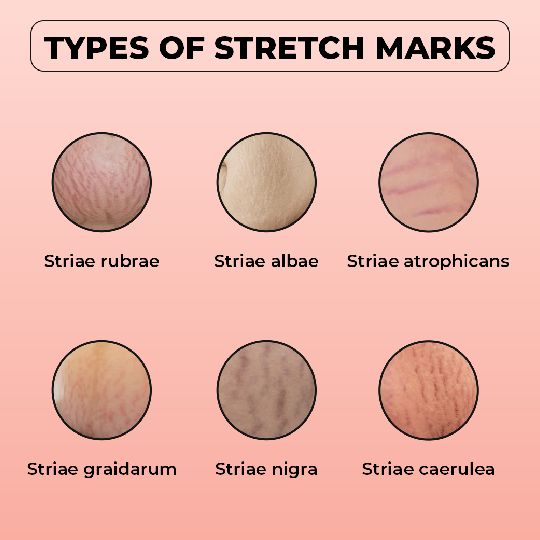 Types of Stretch Marks: Striae Rubrae, Striae Albae, Striae Caerulea, Striae Gravidarum, Striae Nigrae, Striae Atrophicans