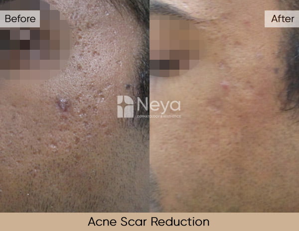 Acne Scars Reduction