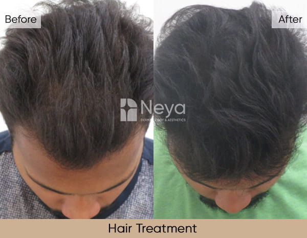 Acne Scars Reduction